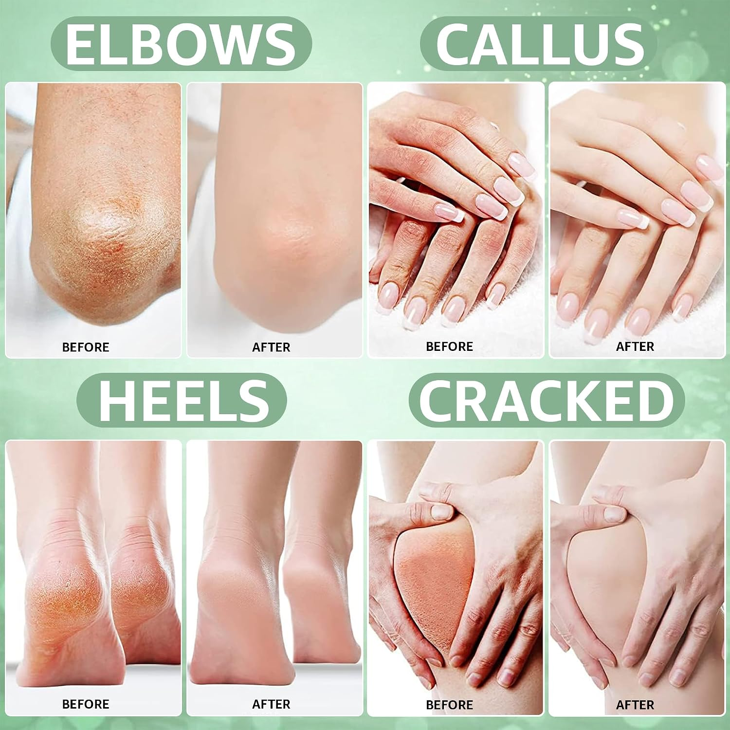 42% Urea Foot Repair Cream for Dry & Cracked Heels - Image 7